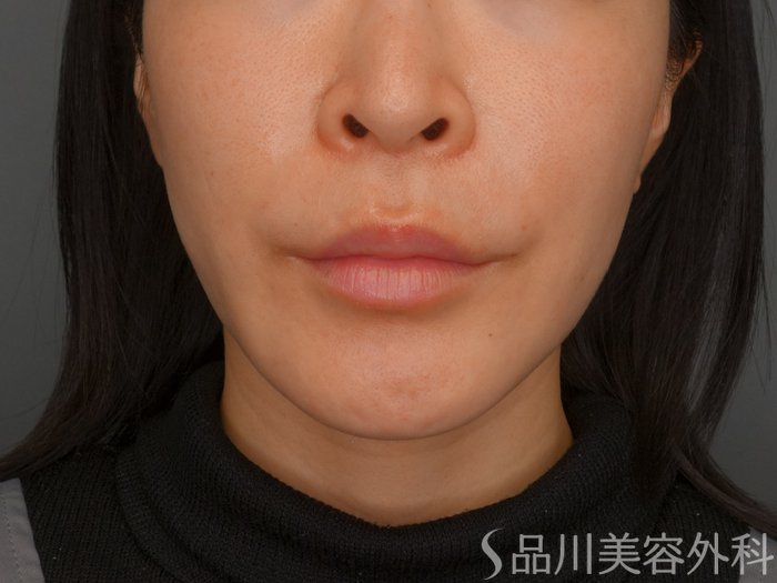 症例NO.74224のBEFORE写真