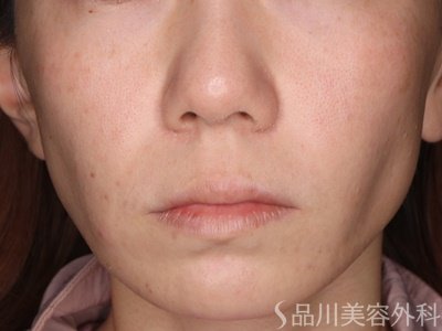 症例NO.72983のBEFORE写真