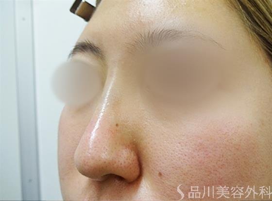 症例NO.33581のAFTER写真