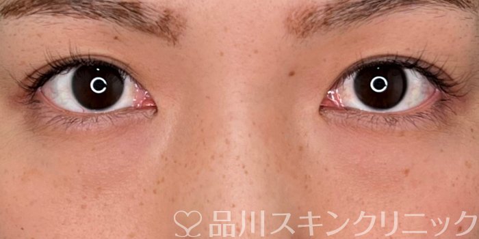 症例NO.70040のBEFORE写真