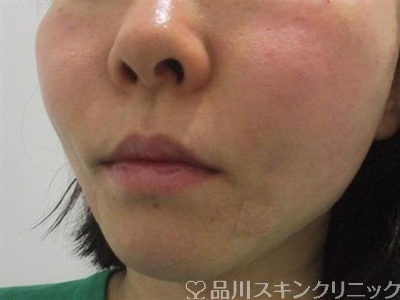 症例NO.35171のAFTER写真
