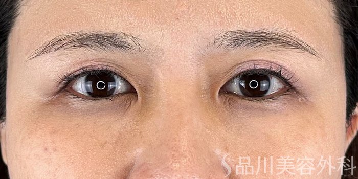 症例NO.70619のAFTER写真