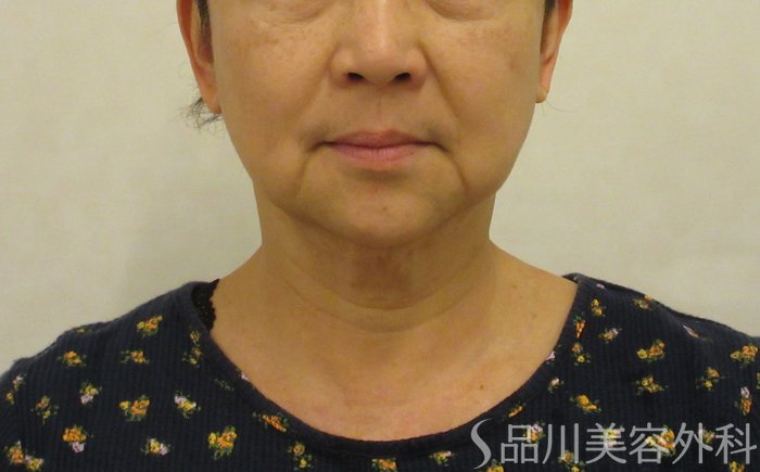 症例NO.73982のBEFORE写真
