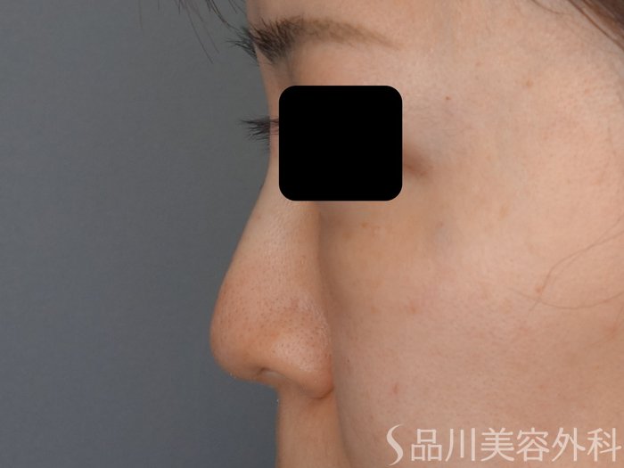 症例NO.72466のAFTER写真