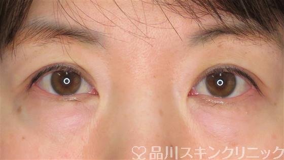 症例NO.49980のBEFORE写真