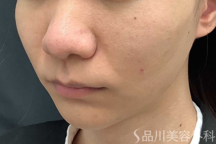 症例NO.63006のAFTER写真