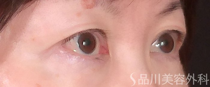 症例NO.70004のBEFORE写真