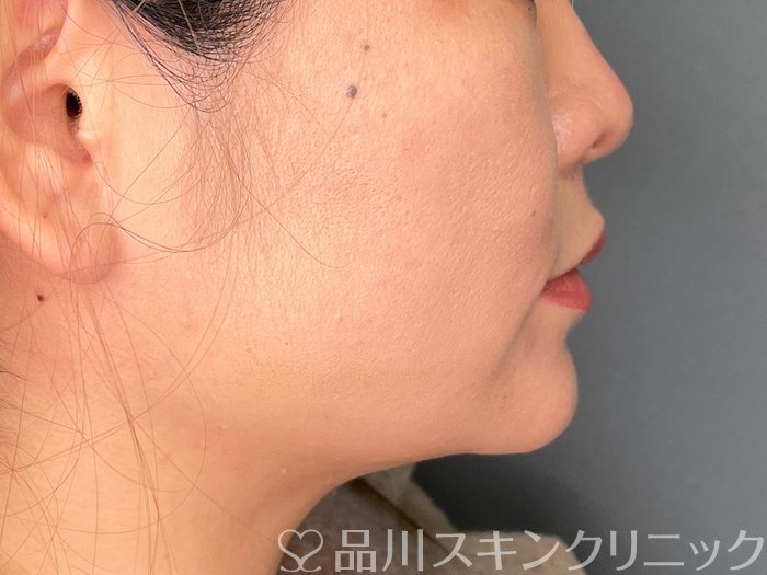 症例NO.73773のAFTER写真