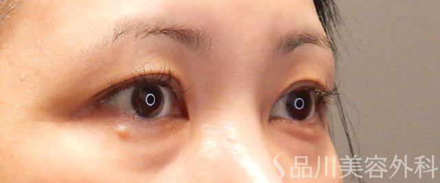 症例NO.72121のBEFORE写真