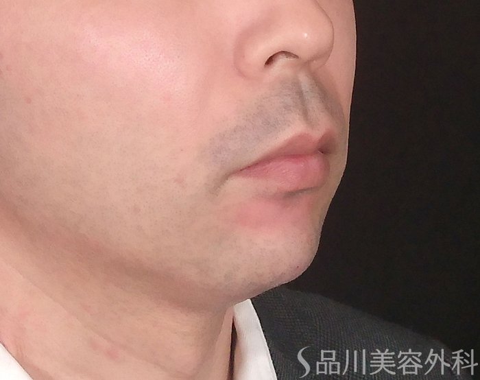 症例NO.69192のAFTER写真