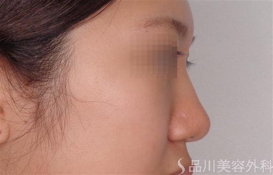 症例NO.47836のBEFORE写真