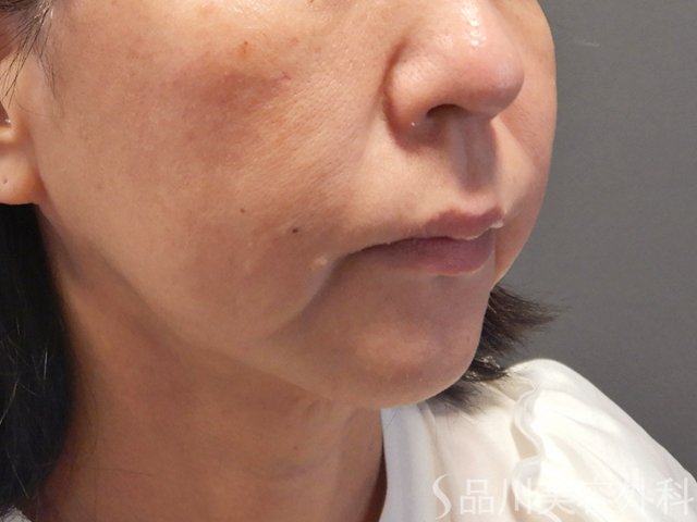 症例NO.72789のBEFORE写真