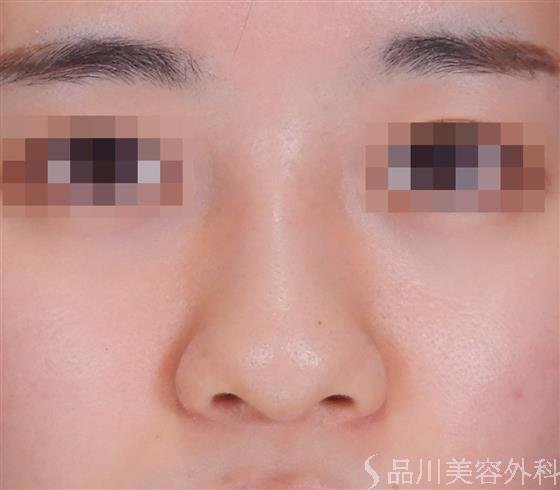 症例NO.58957のAFTER写真