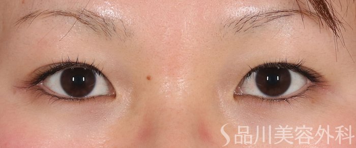 症例NO.73632のBEFORE写真