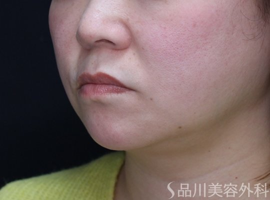 症例NO.72693のBEFORE写真