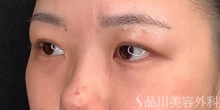 症例NO.71234のAFTER写真