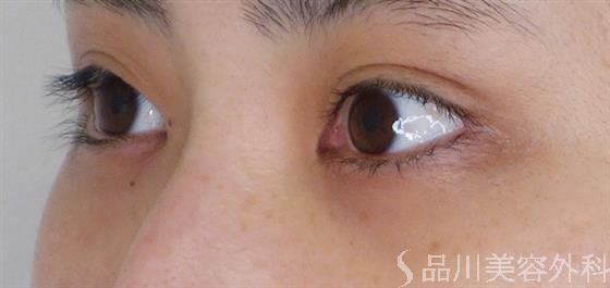 症例NO.52482のBEFORE写真