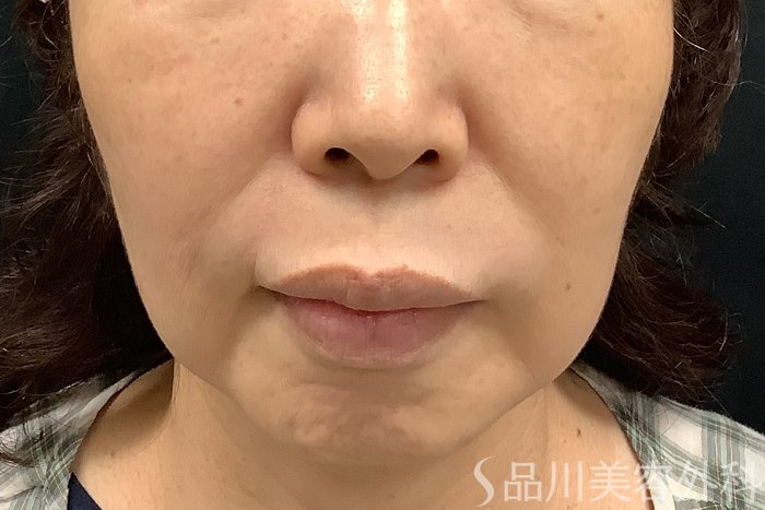 症例NO.71257のBEFORE写真