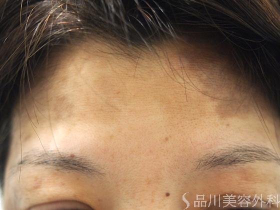 症例NO.22910のBEFORE写真