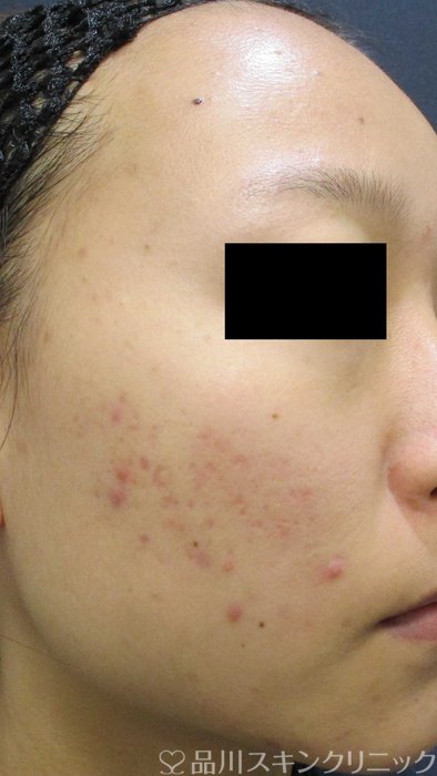 症例NO.70588のBEFORE写真