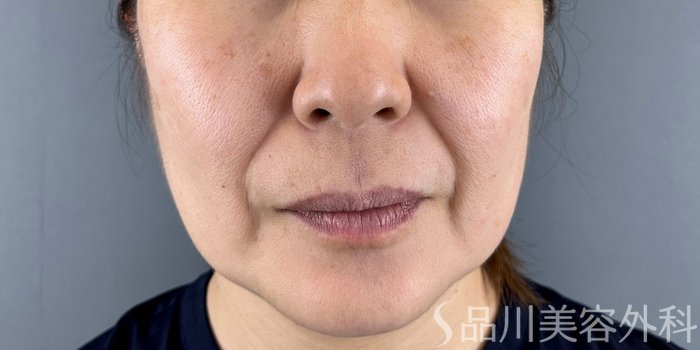 症例NO.71410のBEFORE写真