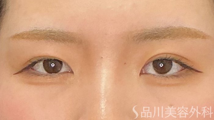 症例NO.72141のAFTER写真