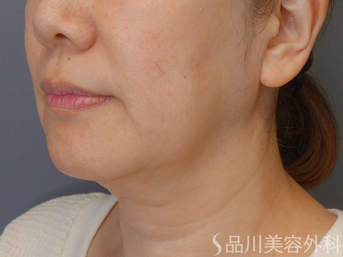 症例NO.70864のBEFORE写真