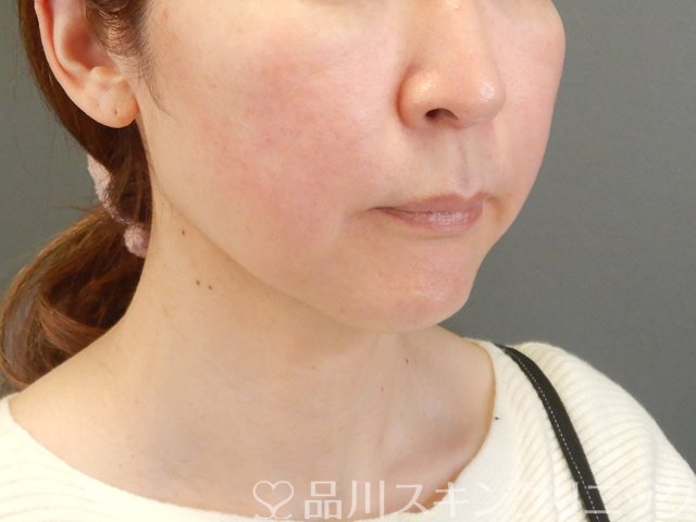 症例NO.63905のAFTER写真