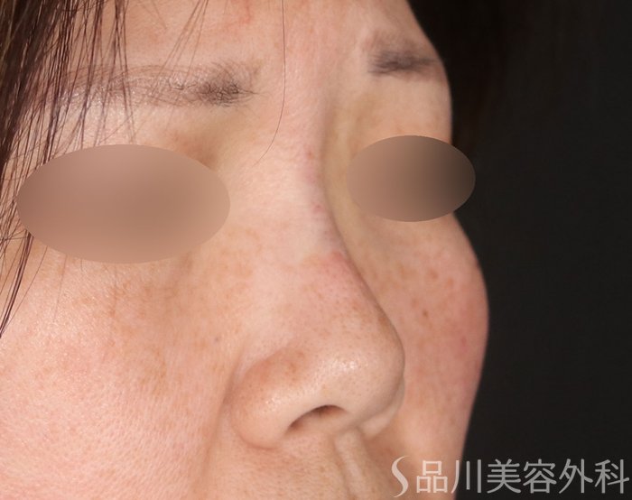 症例NO.72829のAFTER写真