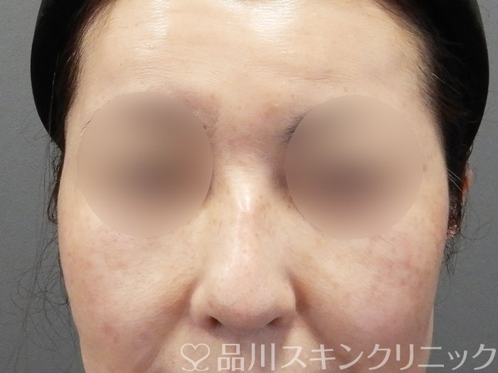 症例NO.75043のBEFORE写真