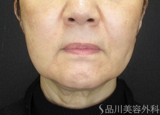 症例NO.69058のBEFORE写真
