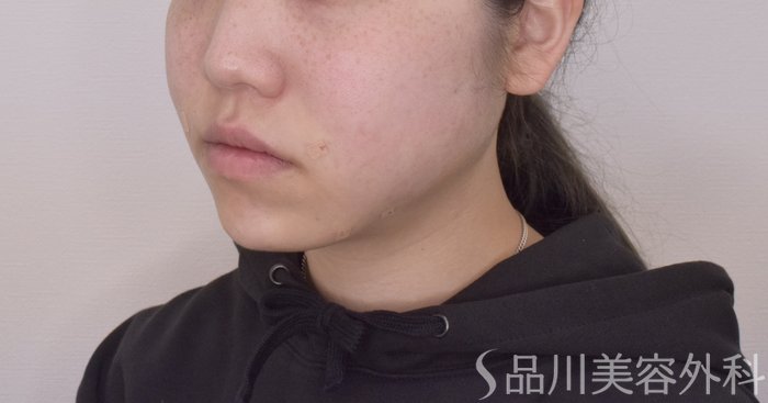 症例NO.64450のAFTER写真