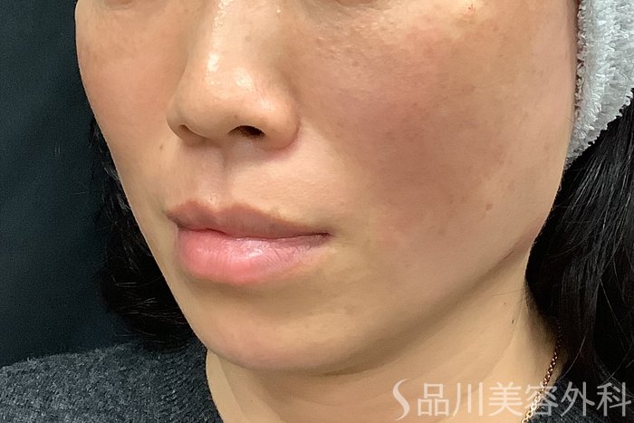 症例NO.73314のAFTER写真