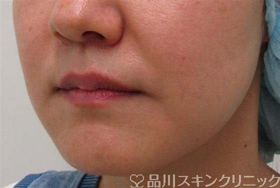症例NO.35438のBEFORE写真