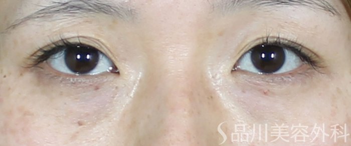 症例NO.71004のBEFORE写真