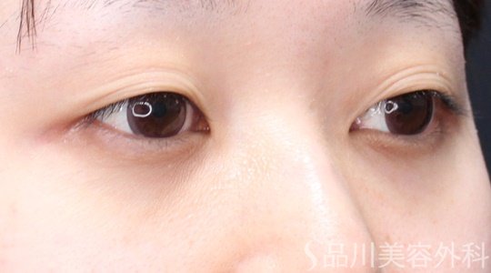 症例NO.70291のBEFORE写真