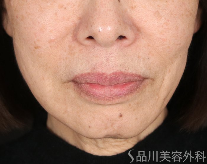 症例NO.72936のBEFORE写真