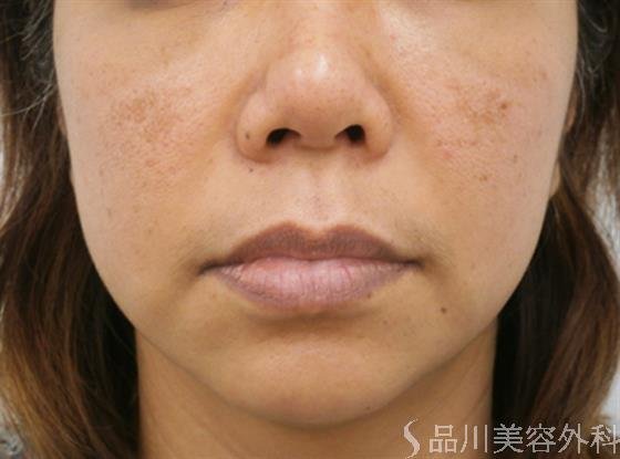 症例NO.30064のBEFORE写真