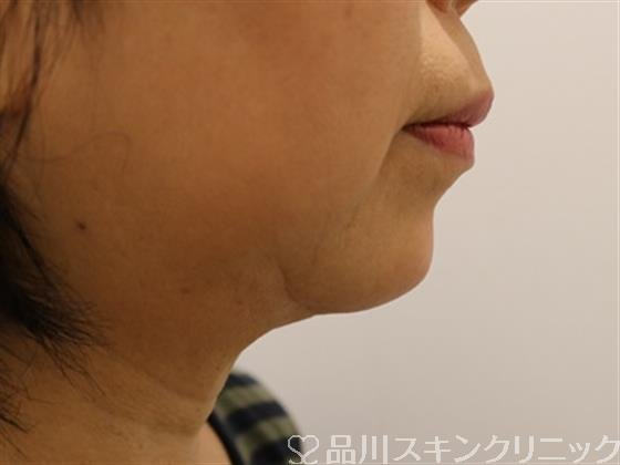 症例NO.43835のAFTER写真
