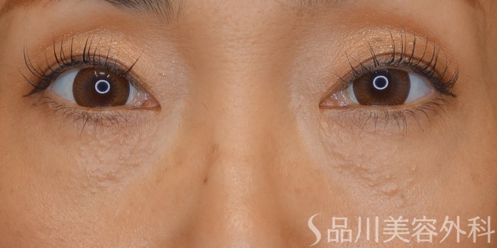 症例NO.72539のAFTER写真