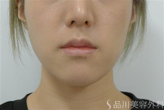 症例NO.38057のBEFORE写真
