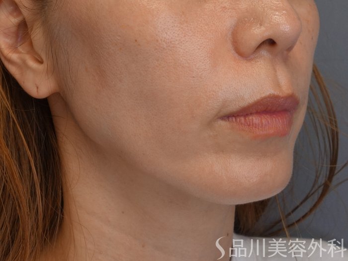 症例NO.72119のBEFORE写真