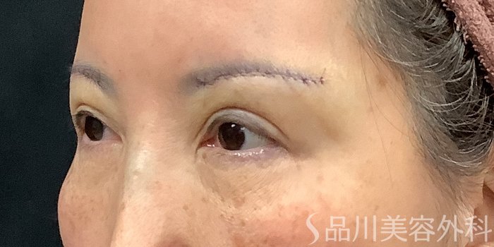 症例NO.73319のAFTER写真