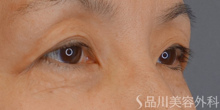 症例NO.72495のBEFORE写真