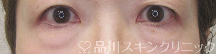 症例NO.70908のBEFORE写真