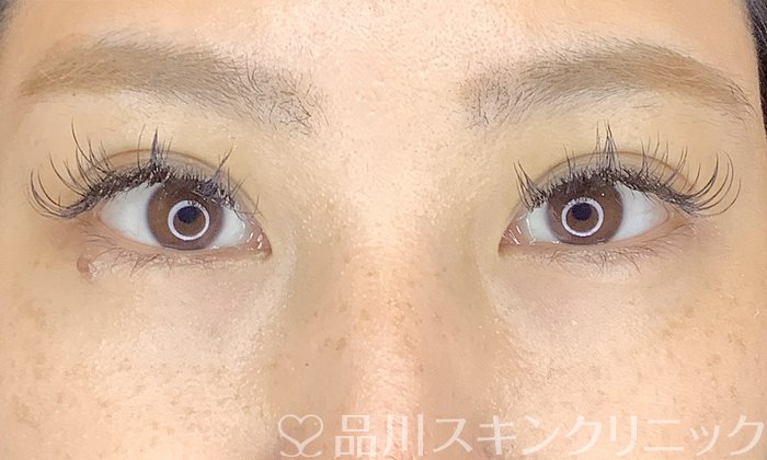 症例NO.70872のAFTER写真