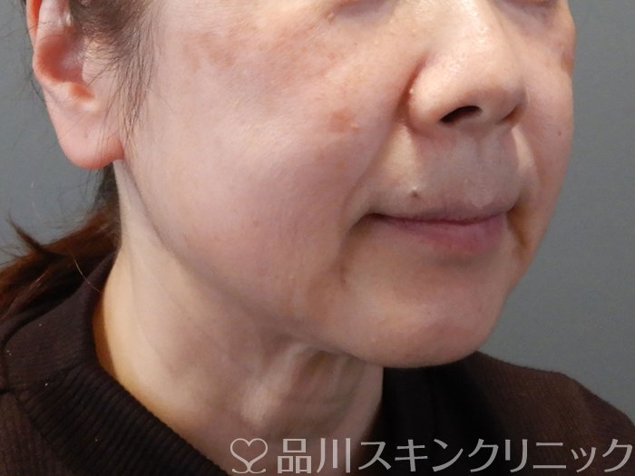 症例NO.73073のBEFORE写真