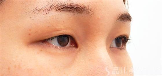 症例NO.53089のBEFORE写真