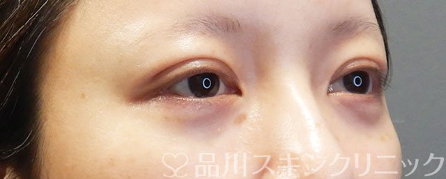 症例NO.74999のAFTER写真