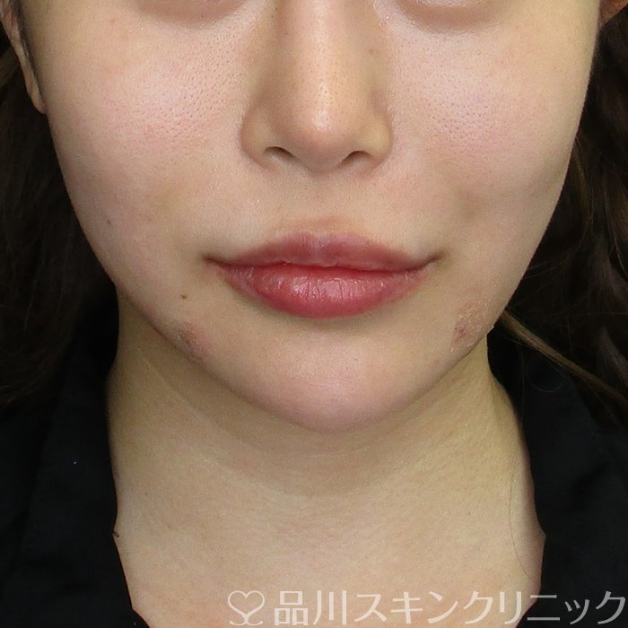 症例NO.74811のAFTER写真